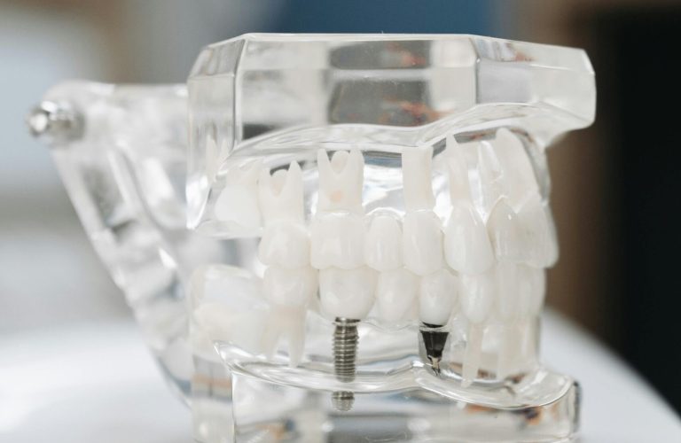 Implantes dentales en Puerto Real